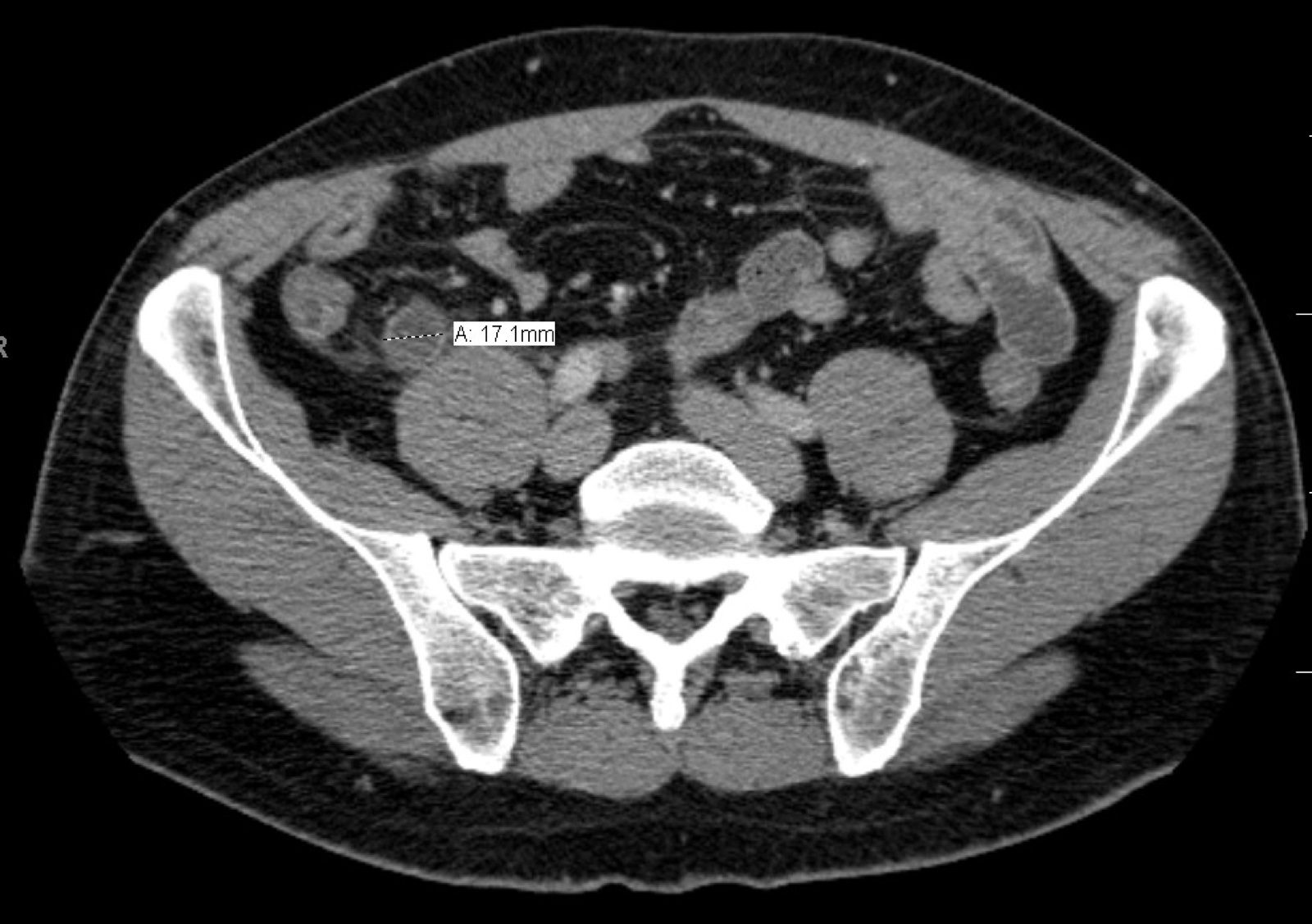 CT scan perut yang menunjukkan usus buntu meradang
