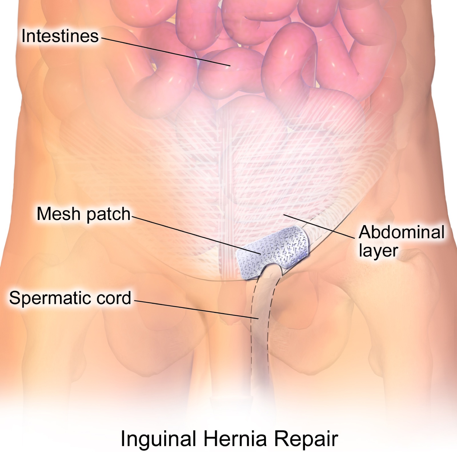 Ilustrasi perbaikan hernia inguinal dengan jaring