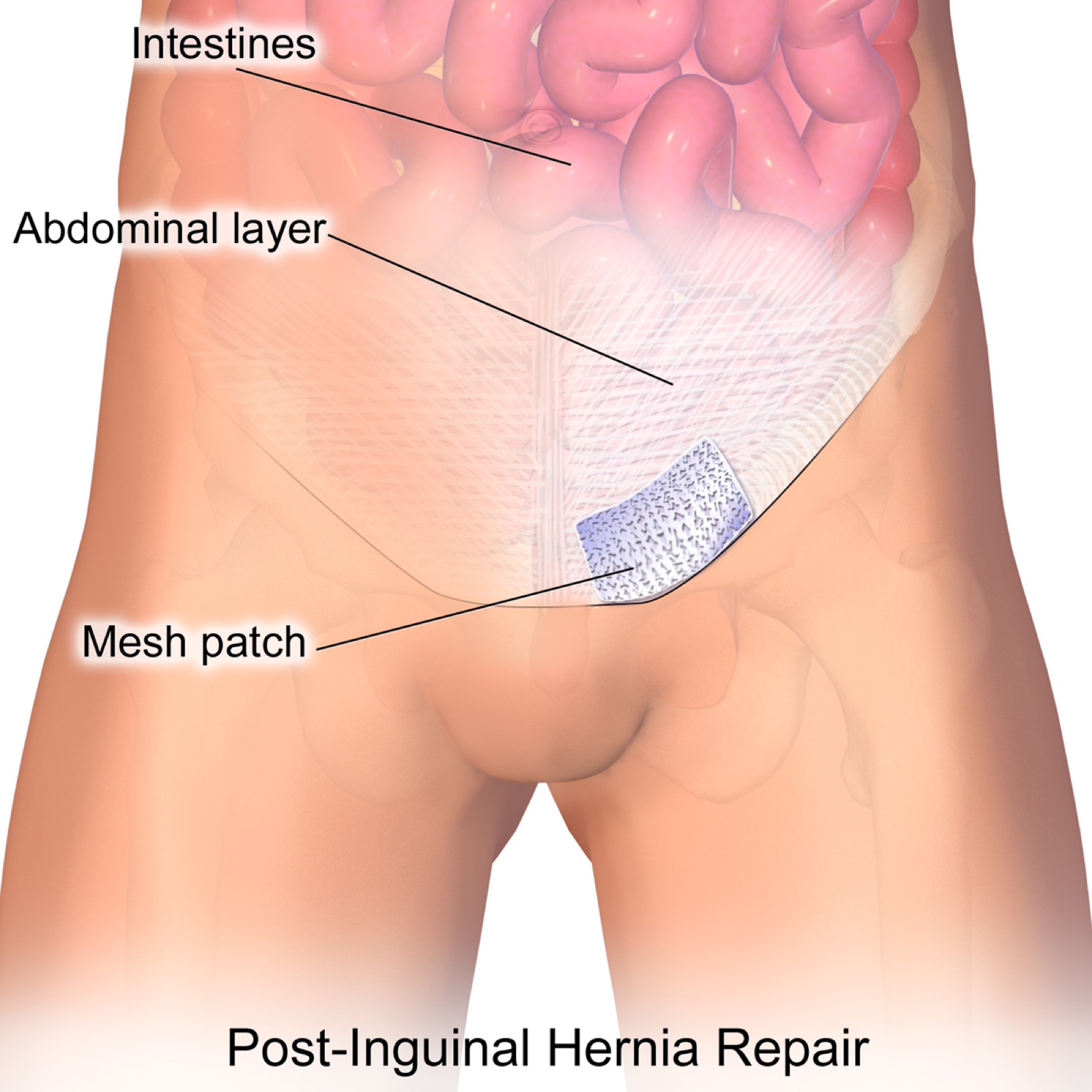 Ilustrasi kondisi setelah perbaikan hernia dengan jaring
