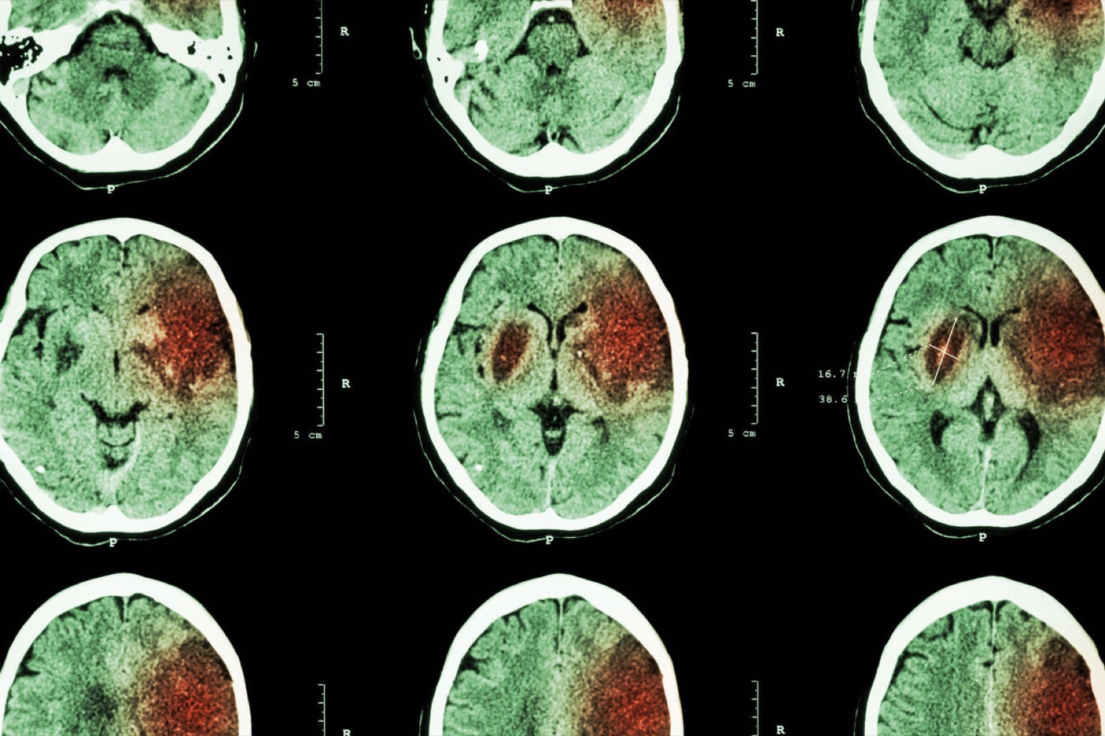 Neurologi (Saraf)