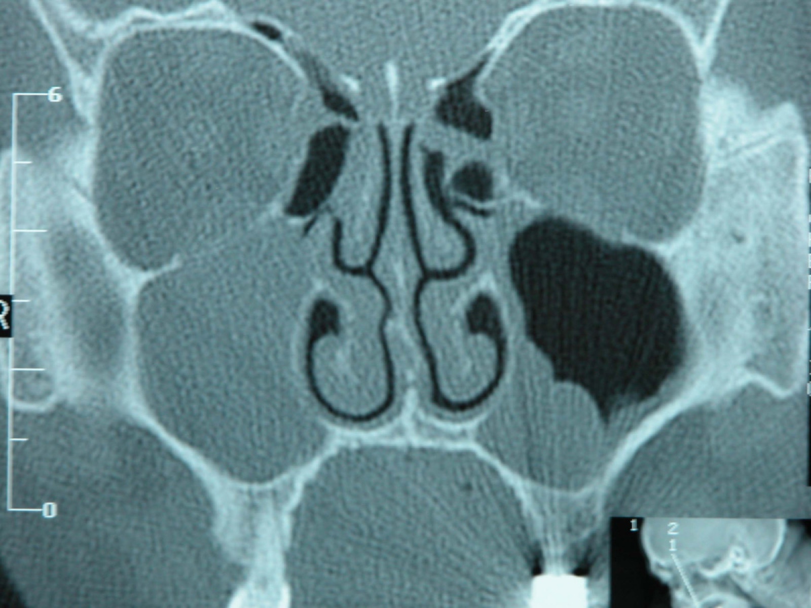 CT scan sinus yang menunjukkan kelainan di rongga sinus